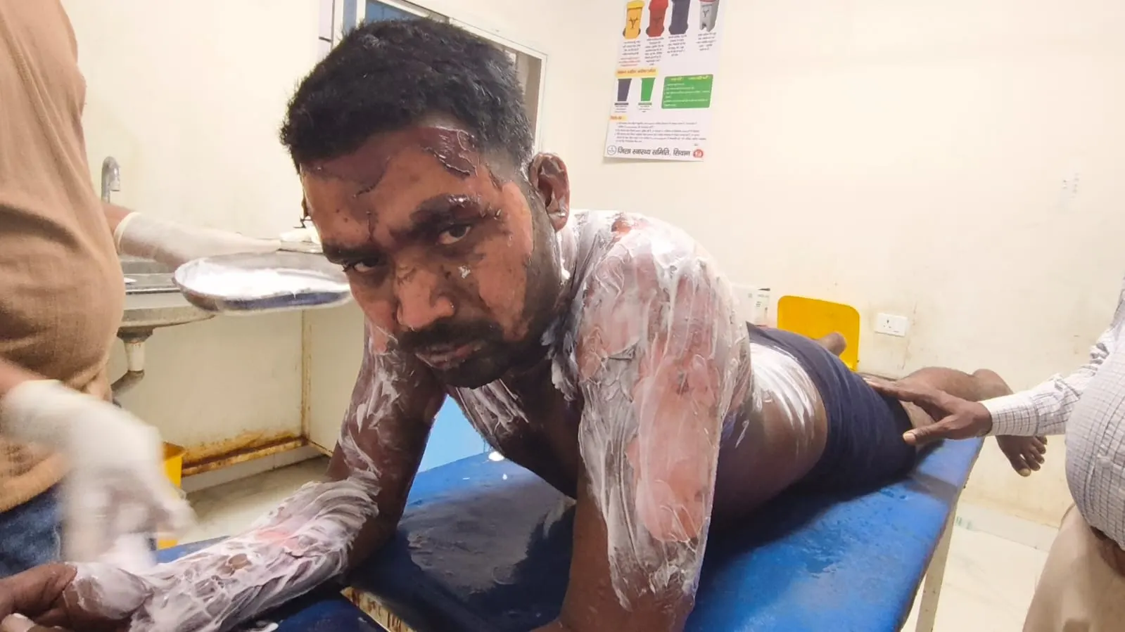 ससुराल बुलाकर युवक को जिंदा जलाने की कोशिश, आधी रात बना खौफ का मंजर