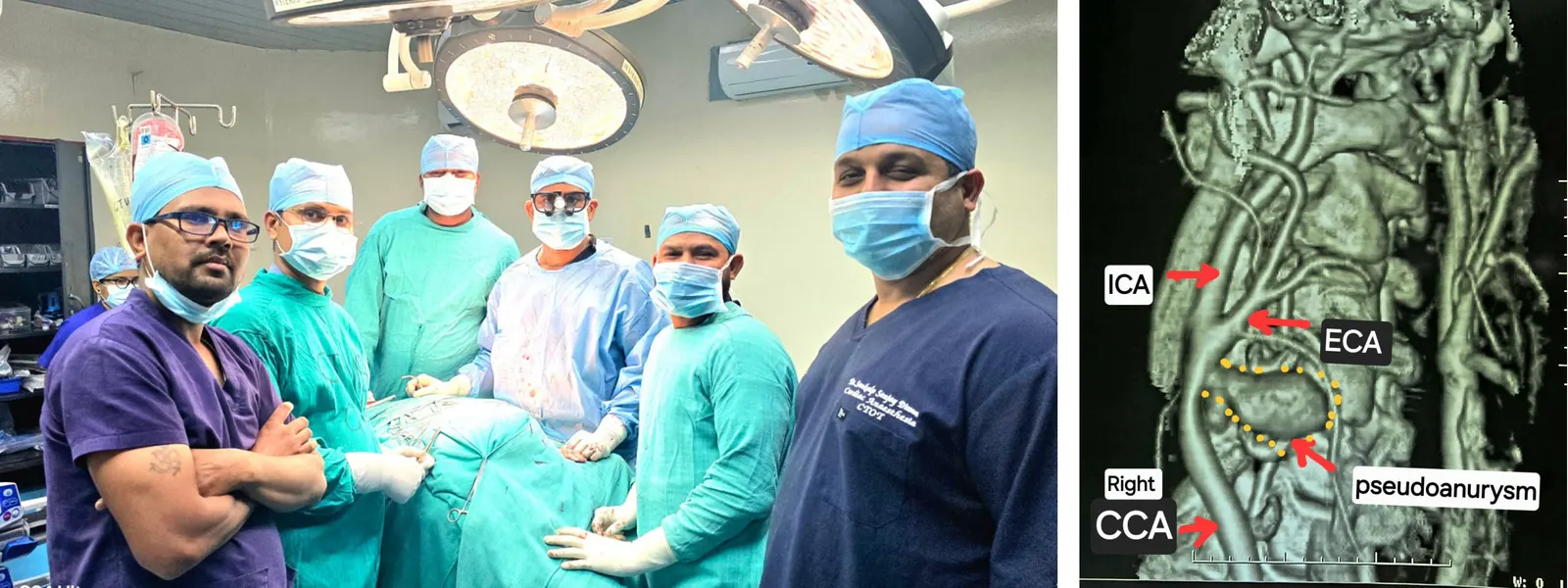 स्पॉन्टेनियस कैरोटिड आर्टरी रप्चर का छत्तीसगढ़ के अम्बेडकर अस्पताल में हुआ सफल उपचार
