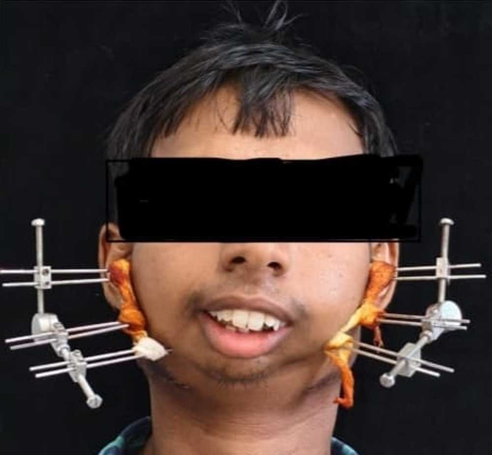 बिलासपुर सिम्स में 24 वर्षीय युवक के बचपन से बंद जबड़े का सफल ऑपरेशन